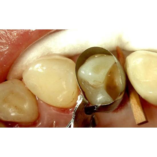 ET Dental Wooden Wedges Kit