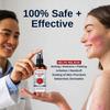 Eczema Therapy Spray-Eczema Treatment-Reduce Itchness And Redness-Prompte New Skin Cell Renewal, 100ml