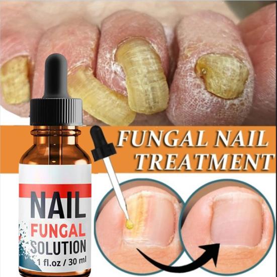 10ml/20ml/30ml Anti Fungus Liquid Toe Finger Nail Infection Repair Treatment