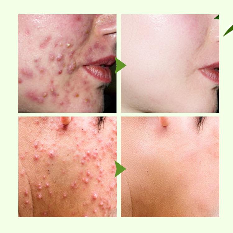 Oligopeptide Acne Clearing Serum Treatment Cream Pore Repair Anti Aging Moisturizing Essence