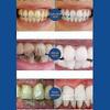 Quick Repair of Cavities Caries Removal of Plaque Stains Rotting Whitening Yellowing Repair Teeth Whitening
