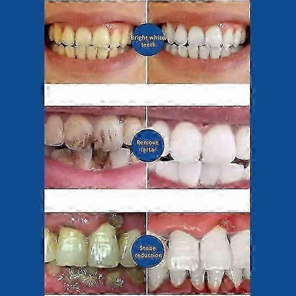 Quick Repair of Cavities Caries Removal of Plaque Stains Rotting Whitening Yellowing Repair Teeth Whitening
