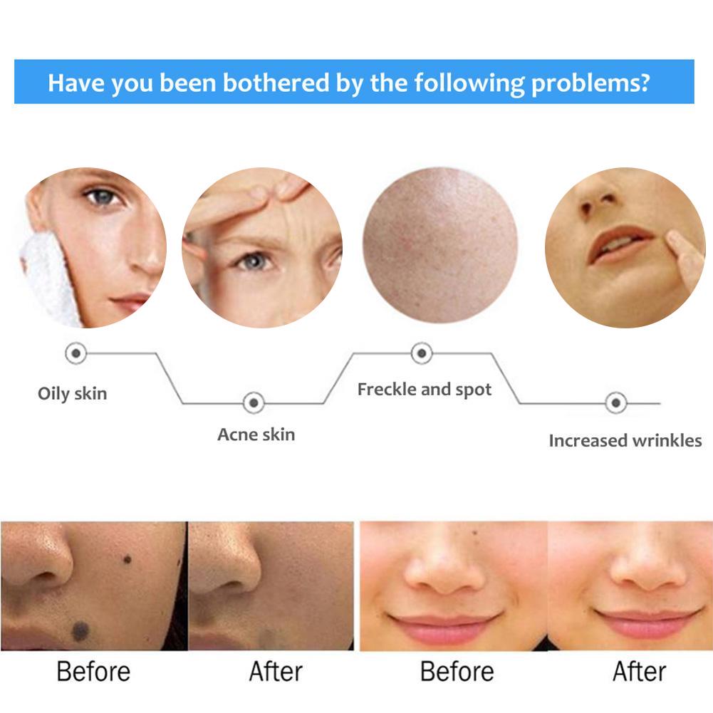 Ultrasonic Freckle Spots Removal Machine Detoxifying Face Care Machine for Home SalonUS Plug 110V