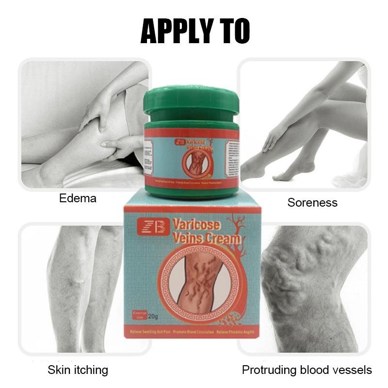 ZB Varicose Veins Relief CreamVasculitis Phlebitis Spider Pain ReliefOintment Medical Plaster Body Care 20g