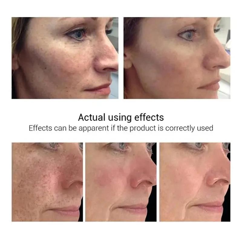 Crème blanchissante efficace pour les taches de rousseur, élimine le mélasma, atténue les taches brunes, hydrate, éclaircit la peau du visage, produit de soin