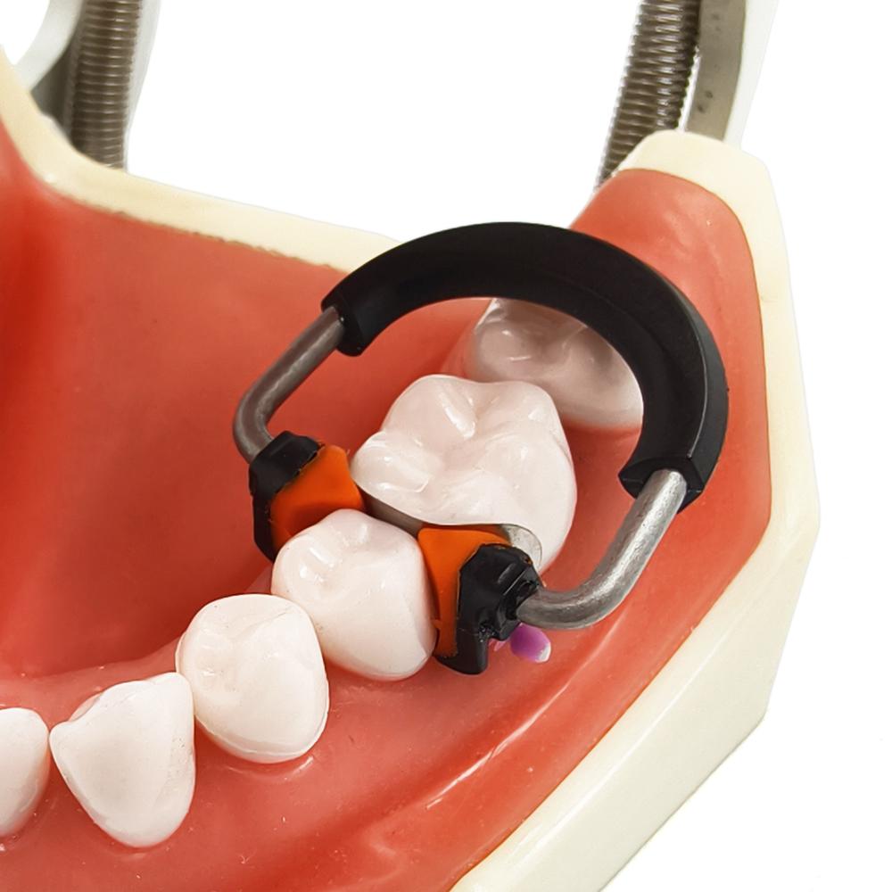 Dental Sectional Matrices Clip Matrix System NITI and Peek Material Ring Matrix Bands Dentistry Instrument Tool