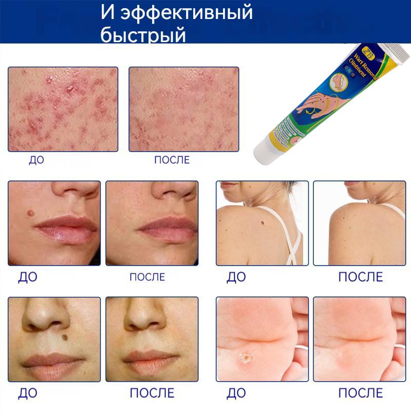 ZB Mole Removal Ointment Skin Care Mild Ingredients Collagen Daily Skin Care