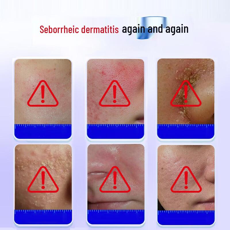 ADPWY Seborrheic Dermatitis Facial Relief Cream