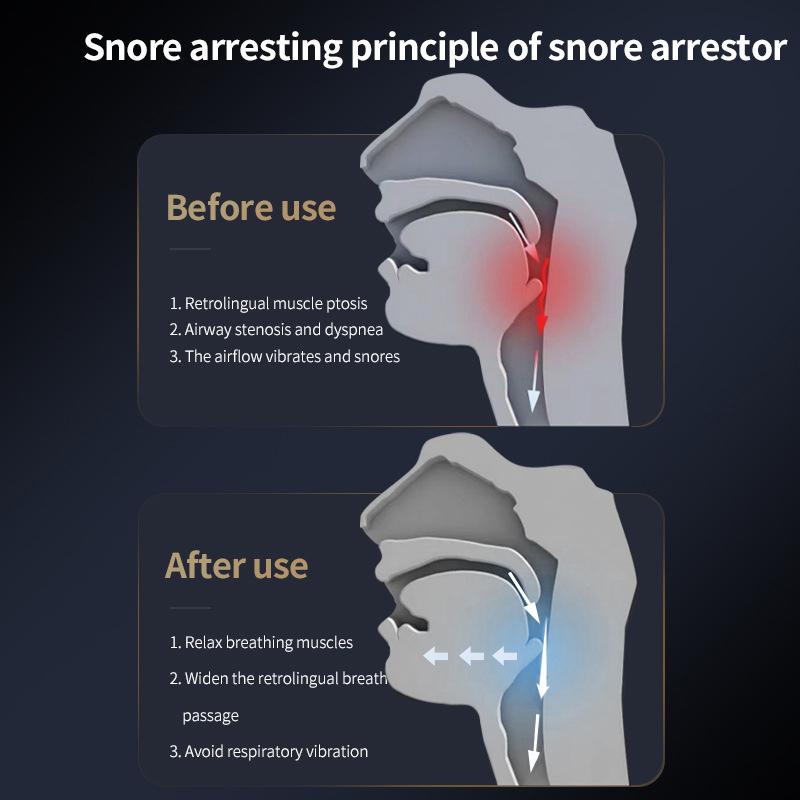 Electric Anti Snore Device Electric Snoring Stop Sleep Nasal Unobstructed Device Intelligent Correction Anti-Snoring Device