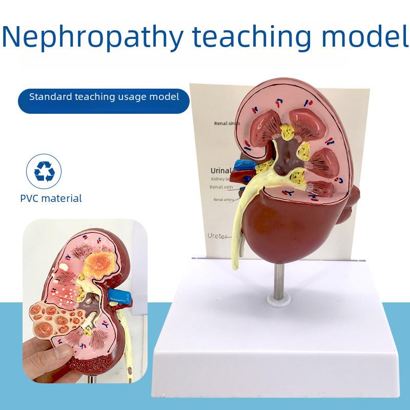 

Human Kidney Pathological Anatomical Model - Urinary System Teaching Tool