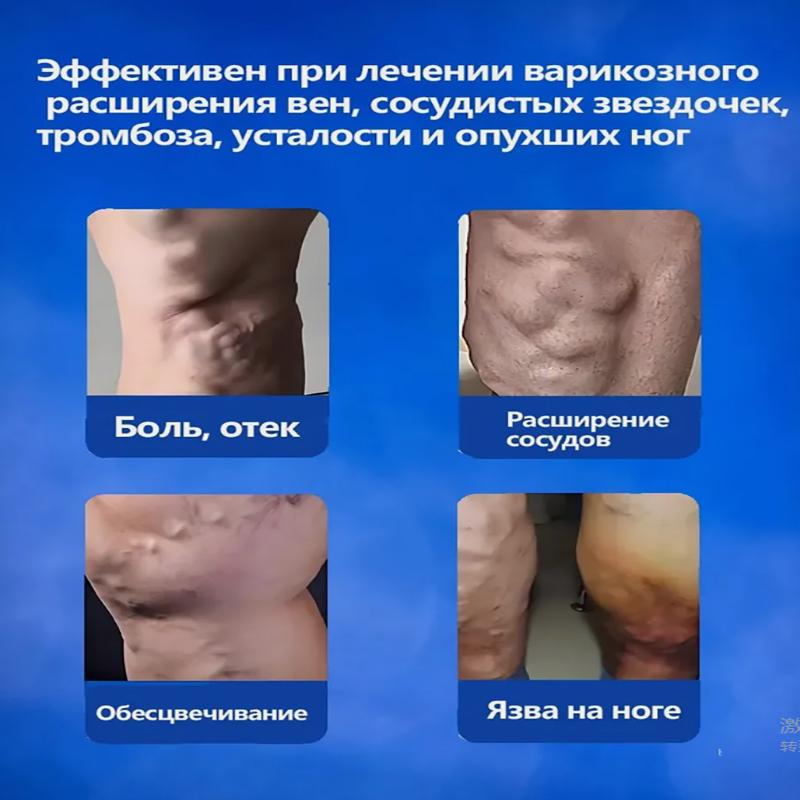 Vein Health Patch, Remove Leg Pain And Swelling Varicose Blood Vessels Earthworm Leg Vein Health Patch