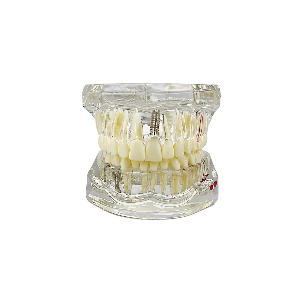 Standard Dental Teeth Model Implant Disease Dentist Studying Demo Dental Typodont Model With Removable Teeth Restoration Bridge