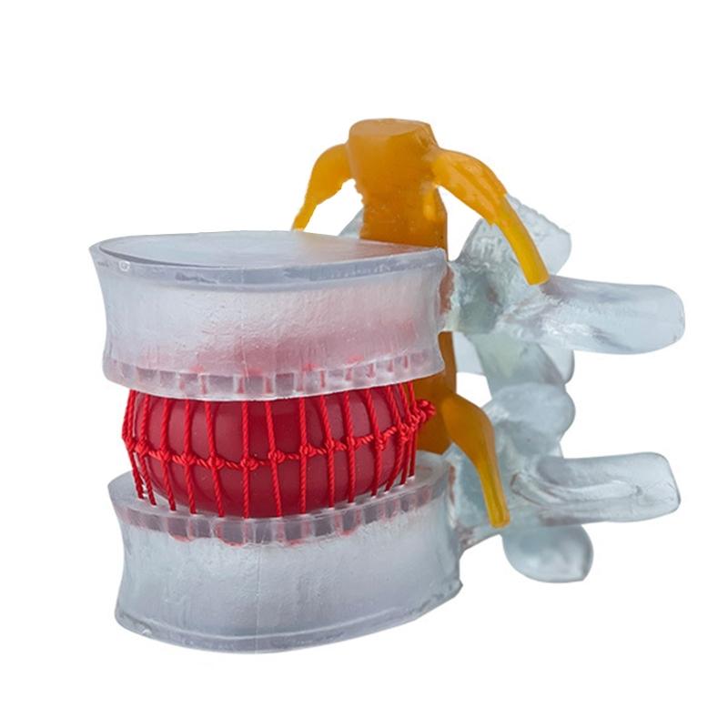 Lumbar Disc Herniation Model Movable Lumbar Spine Model for Hospital 1
