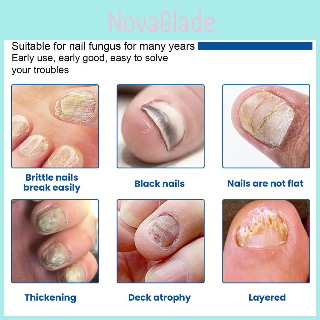 Patchs Réparateurs pour Ongles d'Orteil Ximonth Pour Soin Nourrissant et Adoucissant des Ongles Fongiques