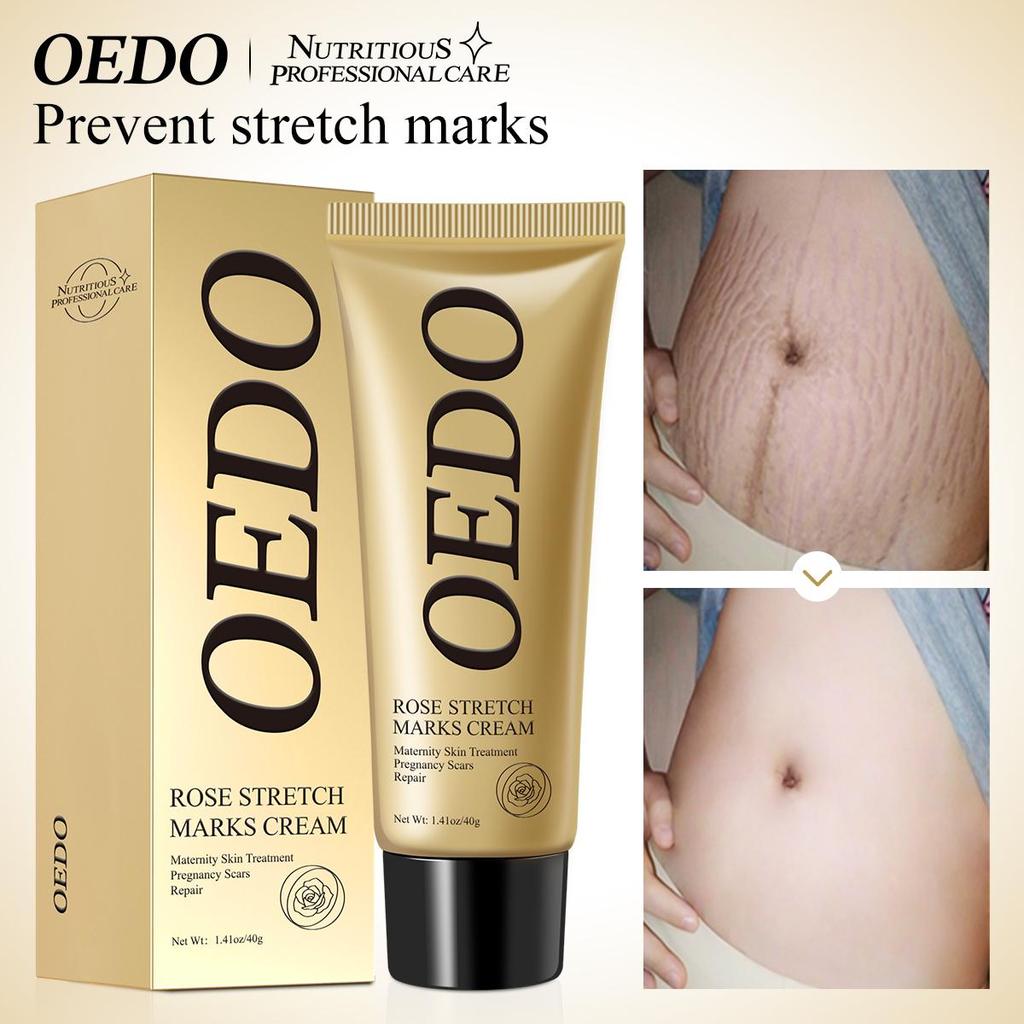 OEDO Rose Pregnancy Cream - Repairs Stretch Marks & Improves Elasticity