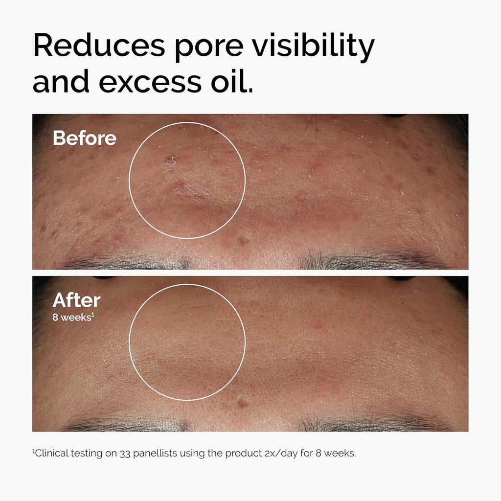 10% Niacinamide 1% Zinc Face Serum 30ml, Oil Control Pore Minimizer, Anti-Acne Dark Spot, Gentle Skin Care for All Skin Types less