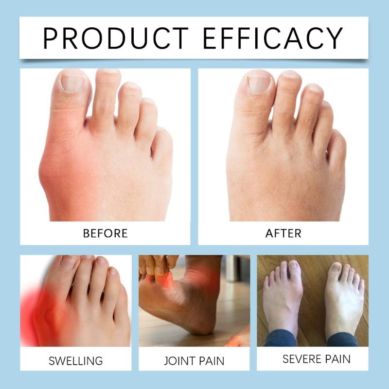 Bunions Corrector for Women Men Orthopedic Bunions Correction Big Toe Separators,Adjustable Bunions Splint Pads Gifts