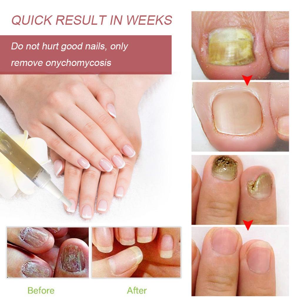 Buy Home Treatment Set Toe Nail Treatment Pen Onychomycosis Paronychia buy-home-treatment-set-toe-nail-treatment-pen-onychomycosis-paronychia