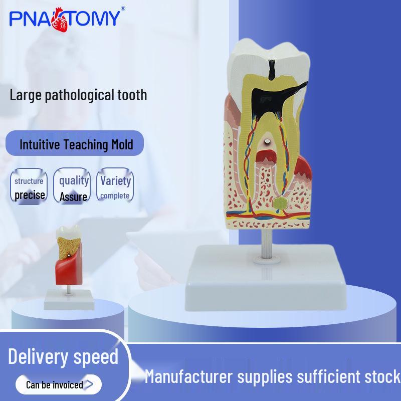 Large Pathological Tooth Model with Cavity Magnification for Dental Anatomy Study 11*11*18 cm