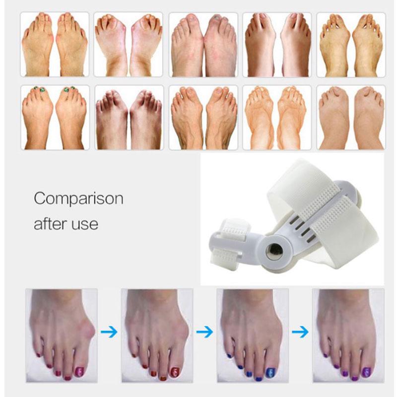 

Toe Orthosis Bone Thumb Valgus Orthosis Unisex Day Night Toe Can Wear Shoes