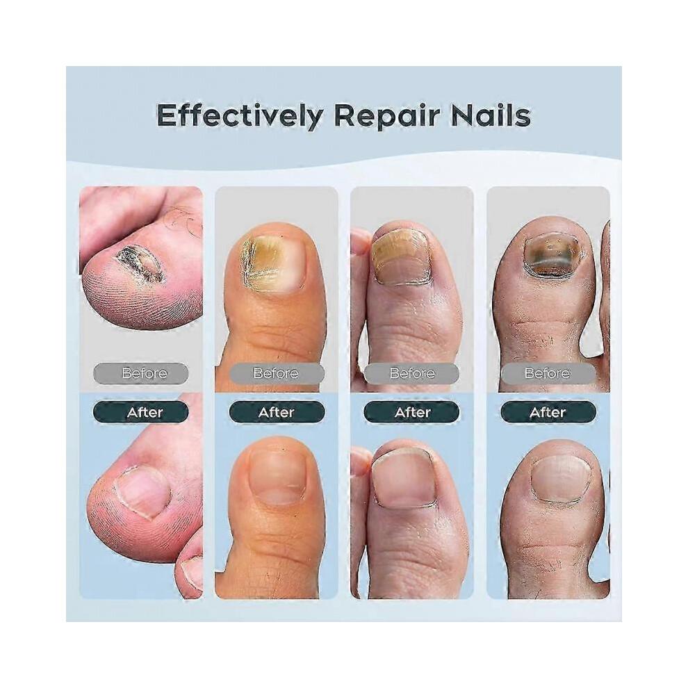 Nail Fungus Laser Treatment Device for Toenails & Fingernails, Home Use 905nm Infrared Light + 470nm Blue Light for Nail Repair 2025