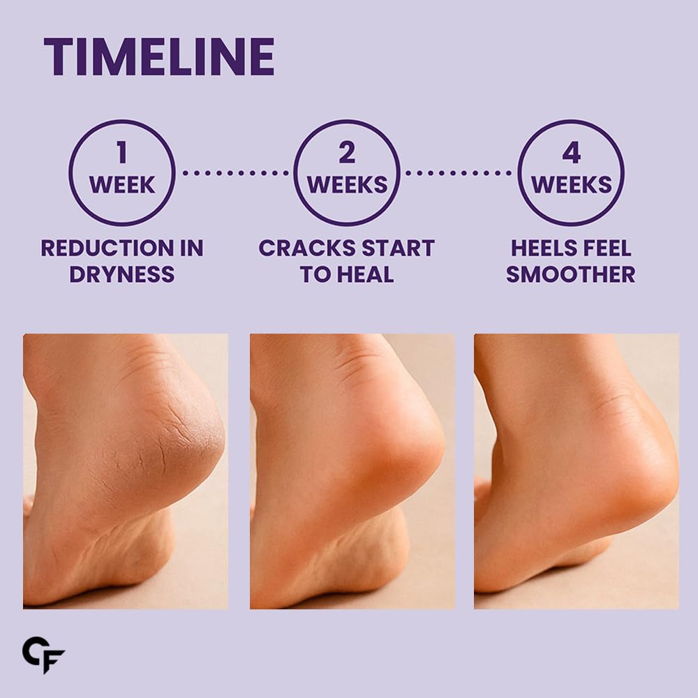 Carbamide Forte 20% Urea Foot Cream Roll-On 50ml For Cracked Heels Moisturising & Repairing Pack of 2