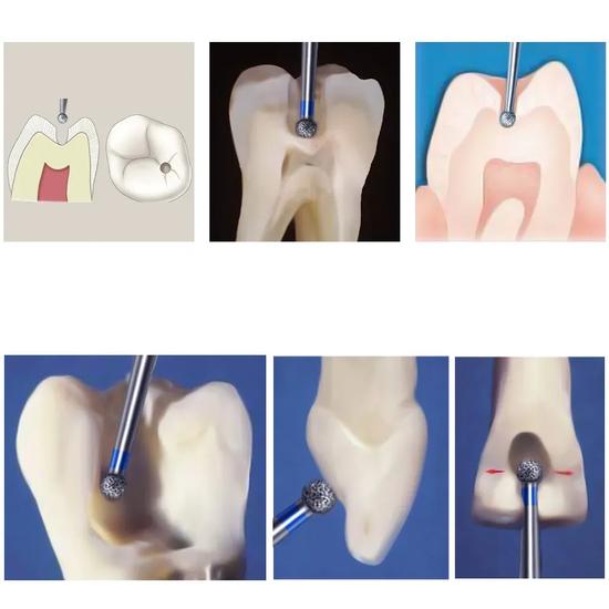 Mani Diamond Bur - Br-46 CA