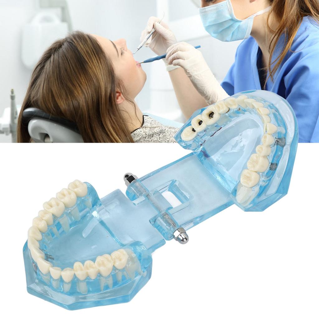 Dental Pathological Model Clear Teaching Detachable Dental Teeth Display Model Blue Transparent