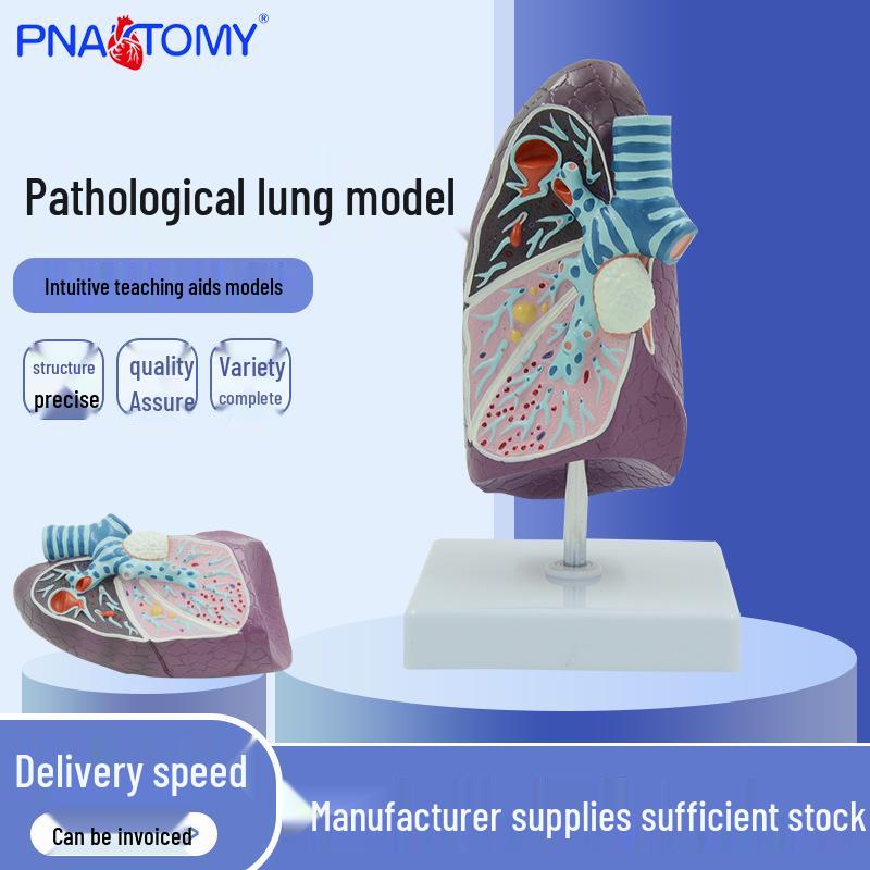 Smoker s Lungs Pathology Model for Thoracic Surgery and Respiratory Medicine Education 11*11*20 cm