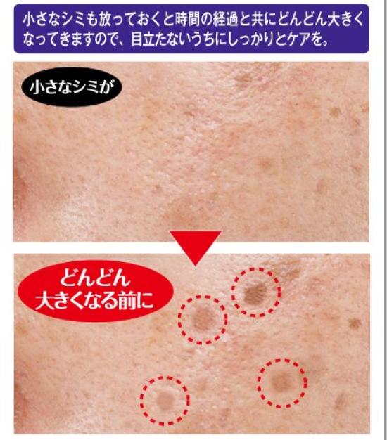 Medicated Shimidas Pack Care Night Pack for Dark Spot (Intensive Skin)