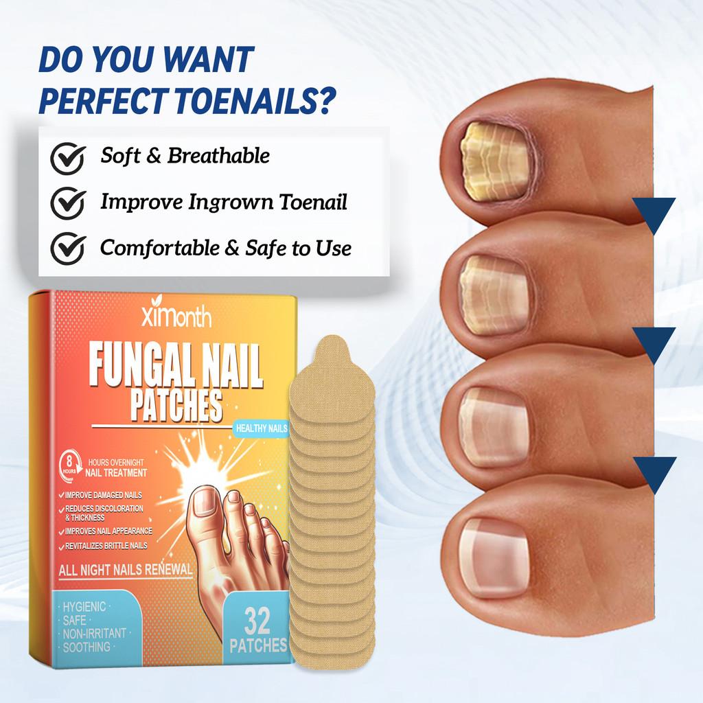 Ximonth Toenail Care Repair Patches For Repairing Protecting And Moisturizing Damaged Nails 32 Pcs