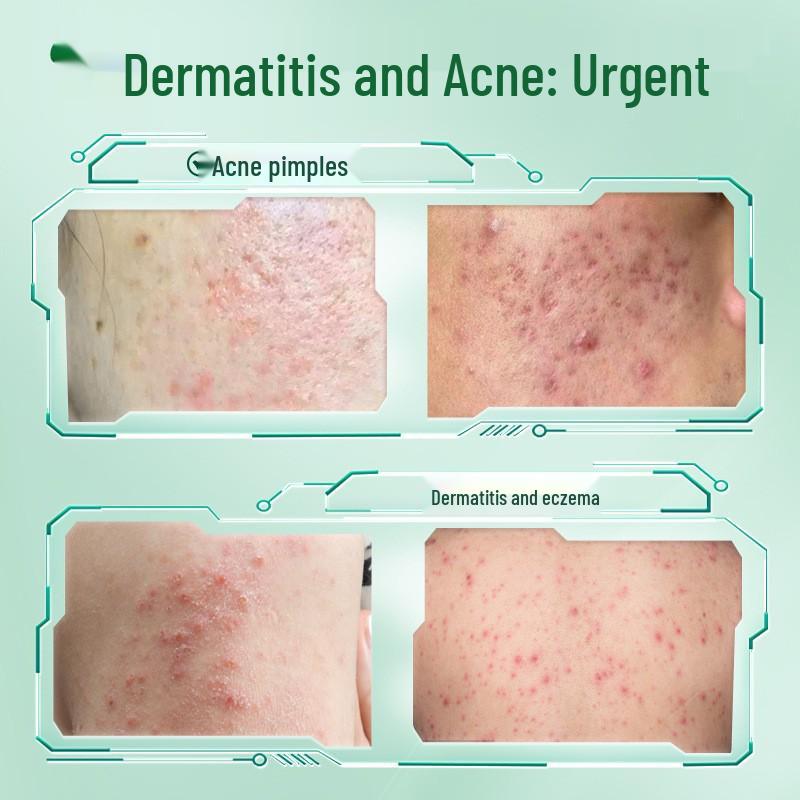 Tuoneng Specialist Skin Care Ointment for Acne, Eczema, Pimples, Seborrheic Dermatitis & Redness.