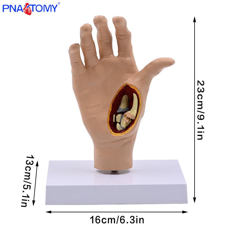 Pathological Hand Model: 1:1 Joint, Tendon, Ligament, Muscle Anatomy Teaching Aid PNT-0750