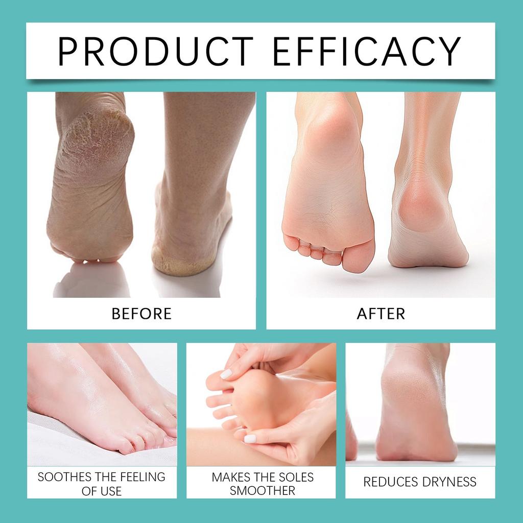 Foot Keratin Remover, Keratin Removal Spray, For Heel Calluses And Dead Skin Foot Care Spray,20ml