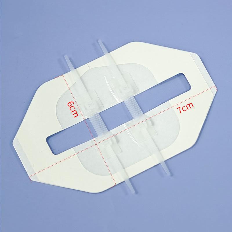 

Zipper-Type Tension Reducer: Suture-Free Medical Wound Closure Device