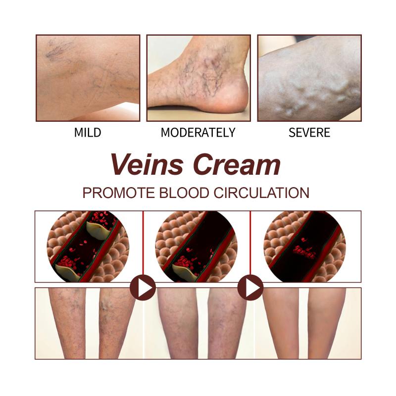 Treatment Cream Relieve Venous Herniation Improve Vasculitis Phlebitis Spider Leg Care Promote