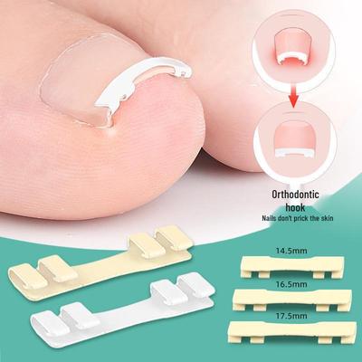 Corrector de Uña Encarnada de Níquel-Titanio: Gancho para Uñas Invisible y Portátil para Alivio del Dolor