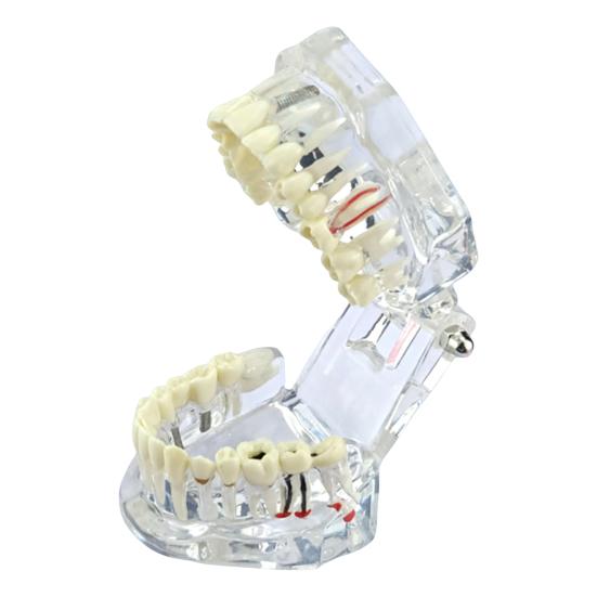 Dental Implant Model Teaching Aid for Dentist Student School Removable Teeth