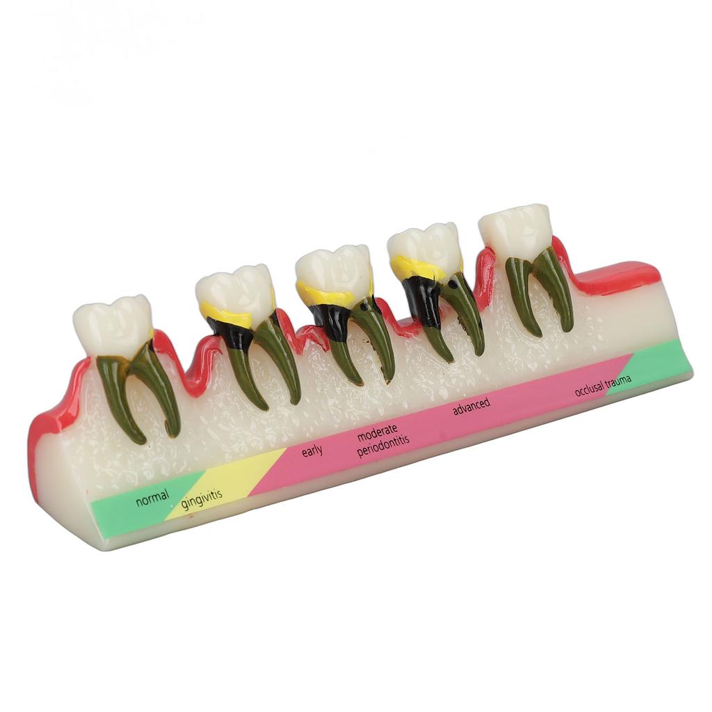 Dental Teeth Model Ceramic Clear Structure Oral Care Educational Periodontal Disease Model