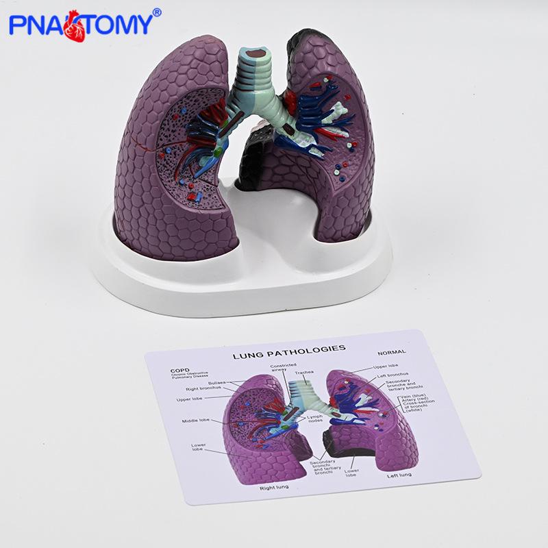 Human Lung Model: Healthy vs. Smoking Lesion for Respiratory Teaching English Guide