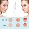 Pimple Extractor Tools,Blackhead Remover,Pimple Popper,Acne Removal Kit Risk Free Treatment,Whitehead Popping,Blackhead Tweezers