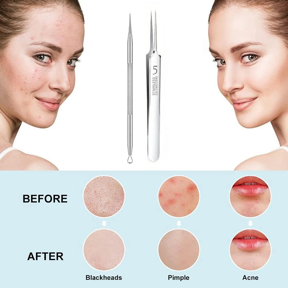Pimple Extractor Tools,Blackhead Remover,Pimple Popper,Acne Removal Kit Risk Free Treatment,Whitehead Popping,Blackhead Tweezers