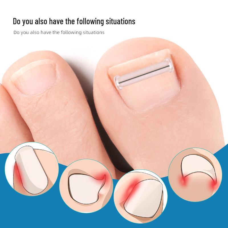 NiTi Alloy Bionic Toenail/Fingernail Corrector for Ingrown Nails