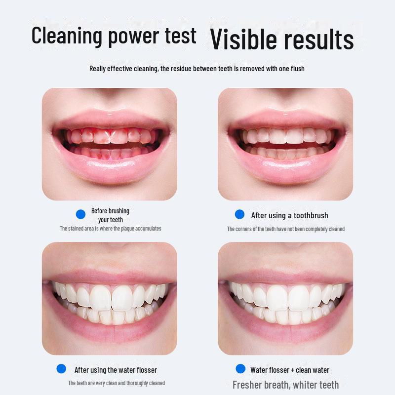 Ouyili Ultrasonic Micro Bubble Water Flosser for Teeth Cleaning