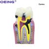 OEING 1Pc Dental Teaching Teeth Model 6 Times Dental Caries Model For Dental Demonstration Model Lab Oral Research Tool