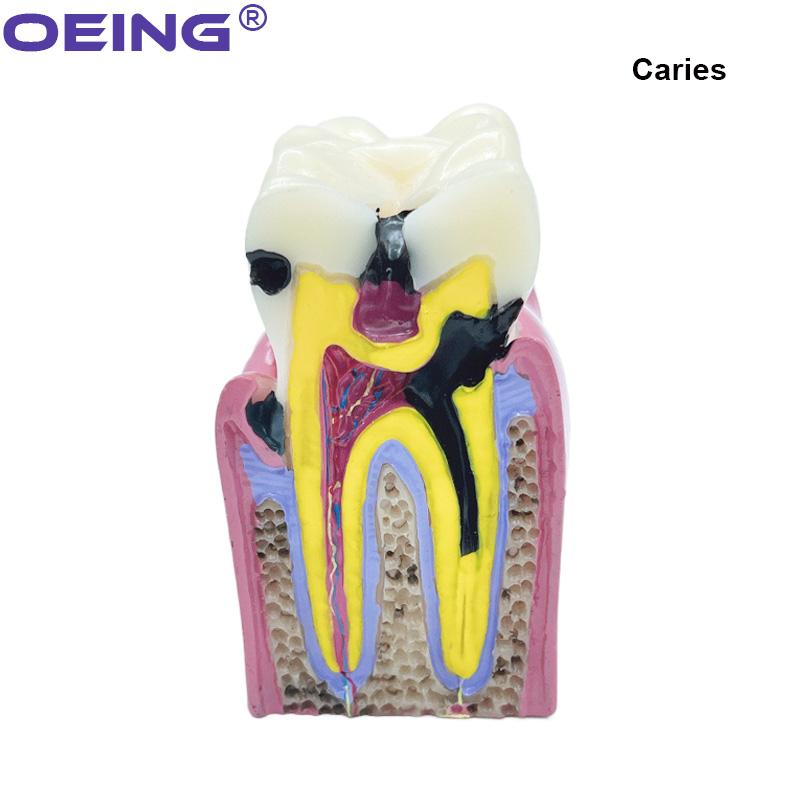OEING 1Pc Dental Teaching Teeth Model 6 Times Dental Caries Model For Dental Demonstration Model Lab Oral Research Tool