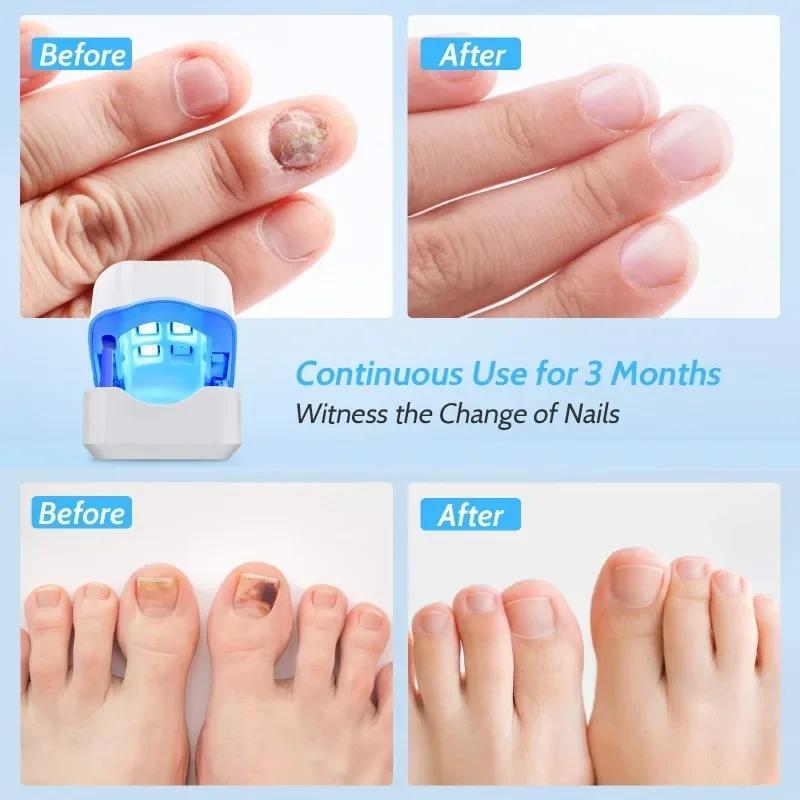 Effective Remover Fungus Machine Repair Nail Laser Fungus Device Damage Rechargeable Cleaning Nail Phototherapy Auxiliary Tools