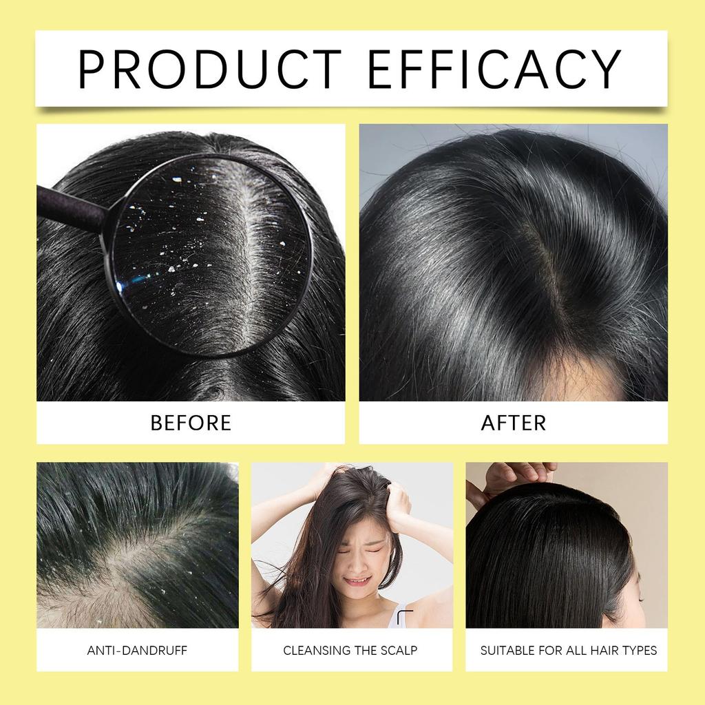 Sulphur Oil Control Anti-Dandruff Shampoo Gently Cleans And Hair And Improves Dry And Frizzy Hair