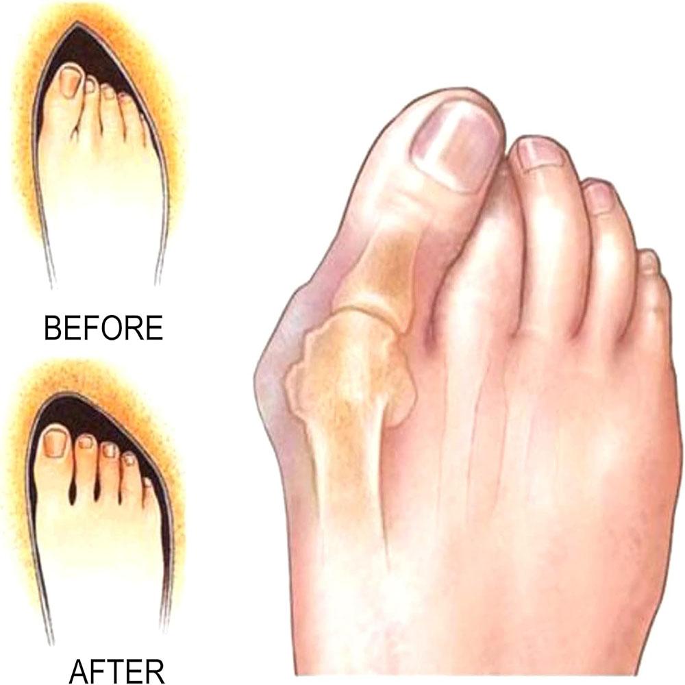 12PCS Gel Toe Separator Toes Spacer Orthotics Pain Relief Silicone