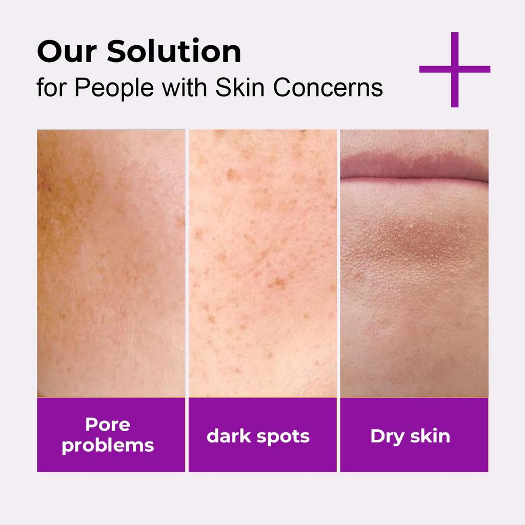 Azelaic Acid Serum-Eliminate Acne And Acne Scars-Inhibit The Growth Of Melanin-Soothing and Repairing Skin-Suitable For All Skin Types, 30ml